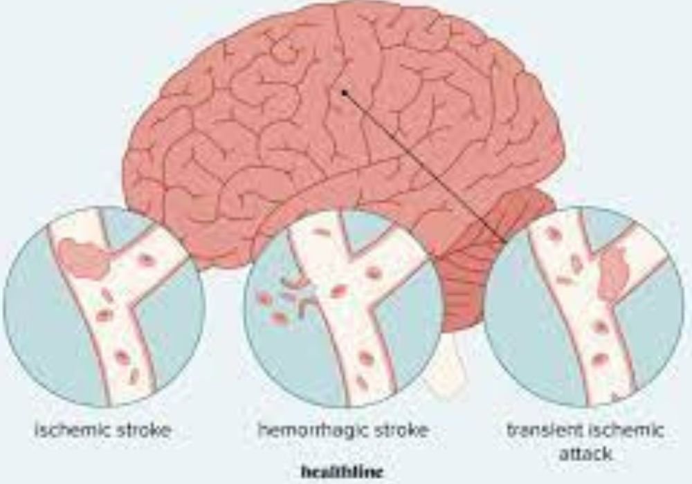 Stroke physiotherapy