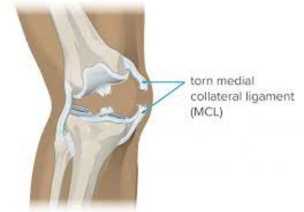 Medial collateral injury 