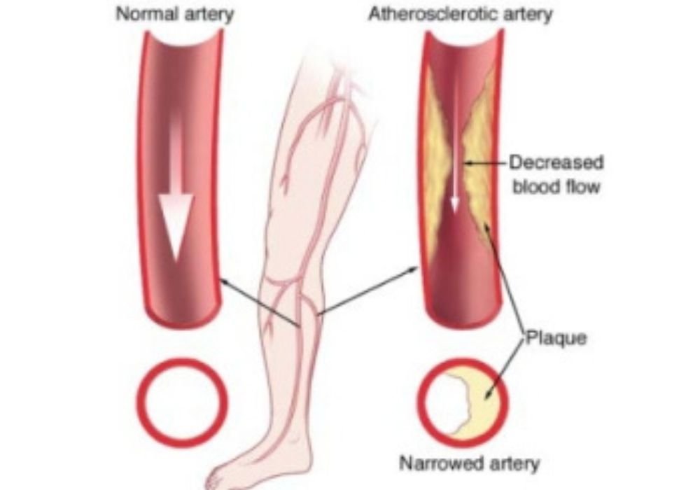 Peripheral vascular disease 