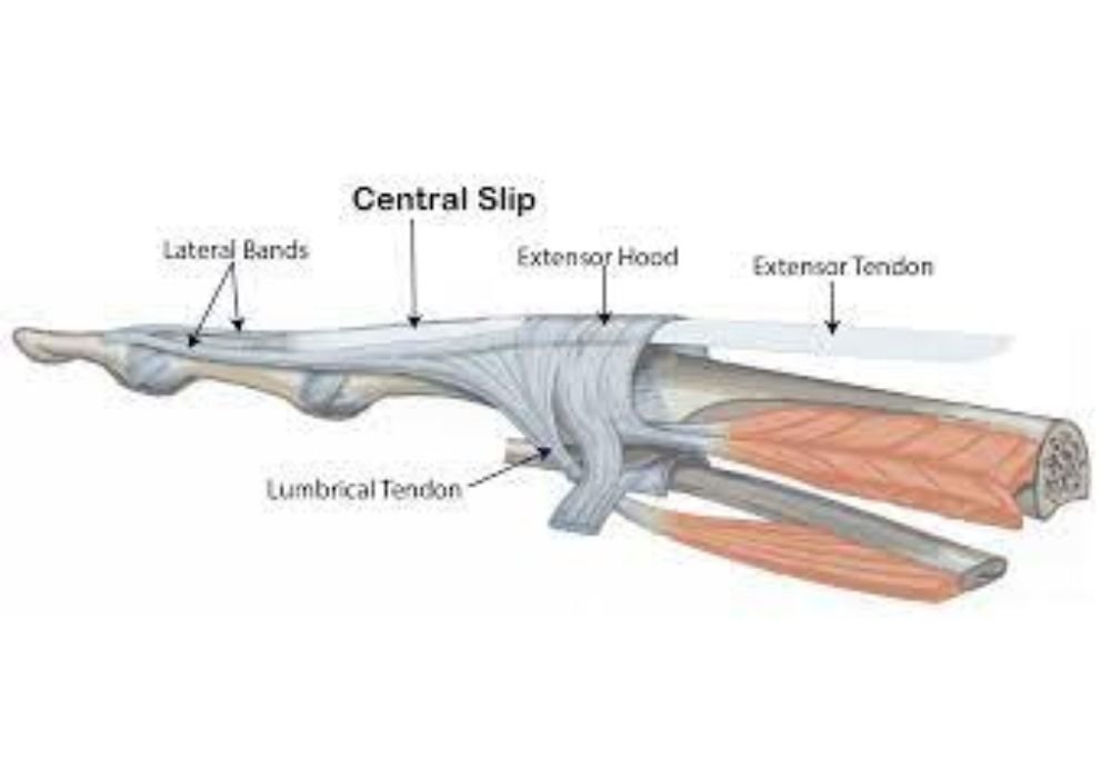 Central Slip Extensor Tendon Injuries