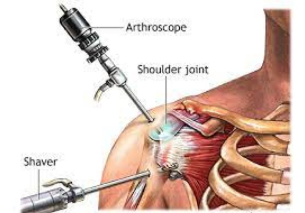 Shoulder(arthroscopy)