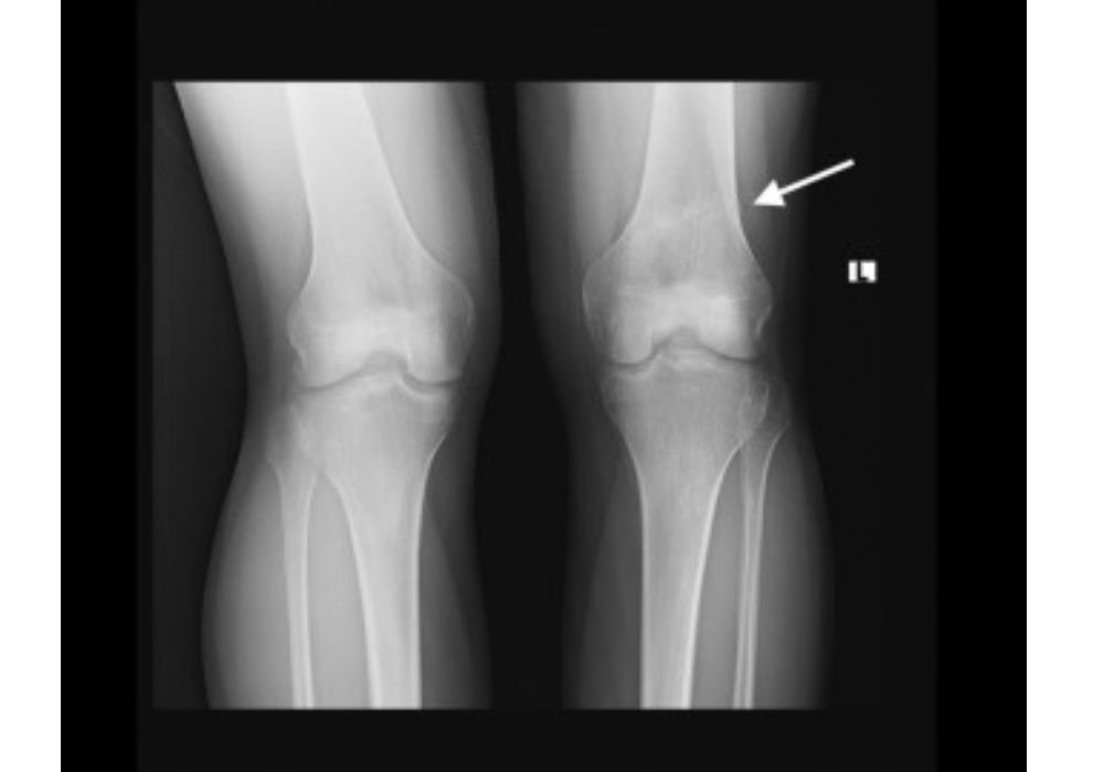 Femoral stress fracture