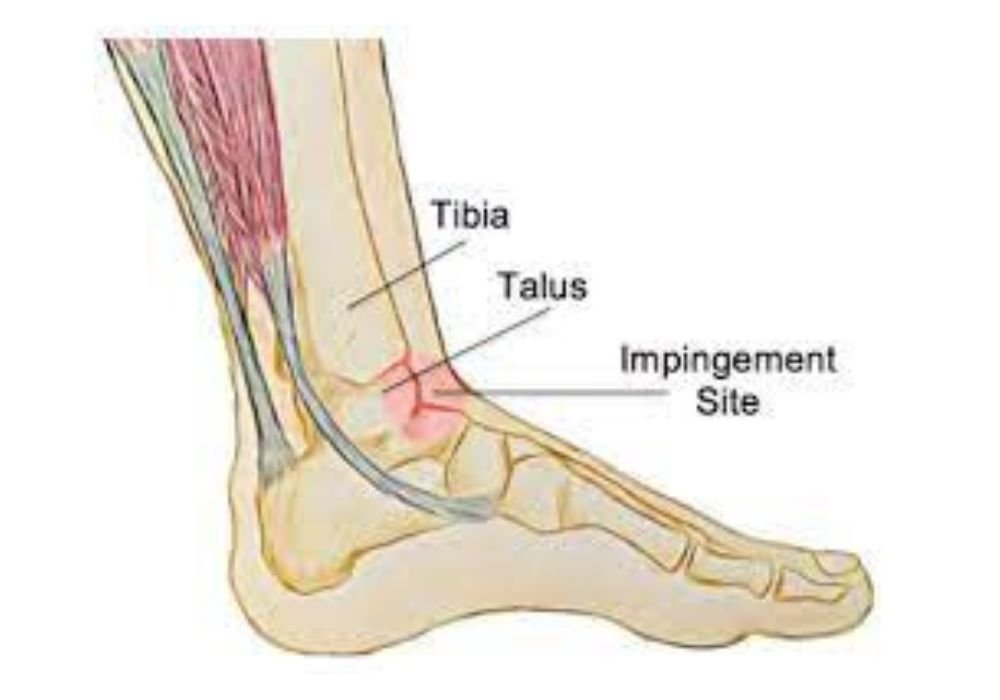 Anterior Ankle Impingement Syndrome