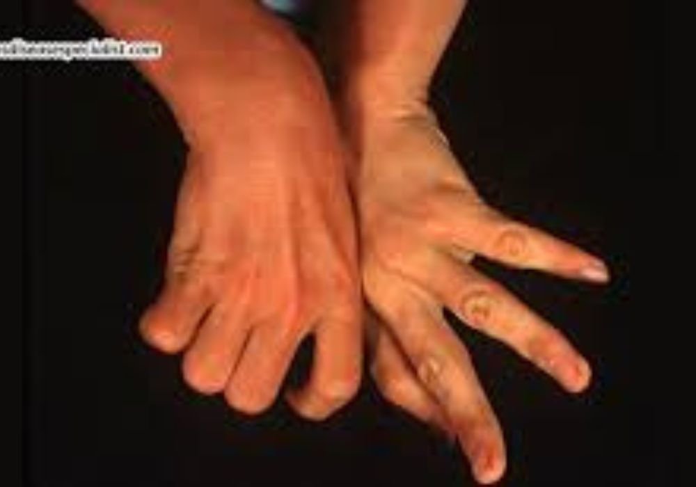 Hand Dystonia