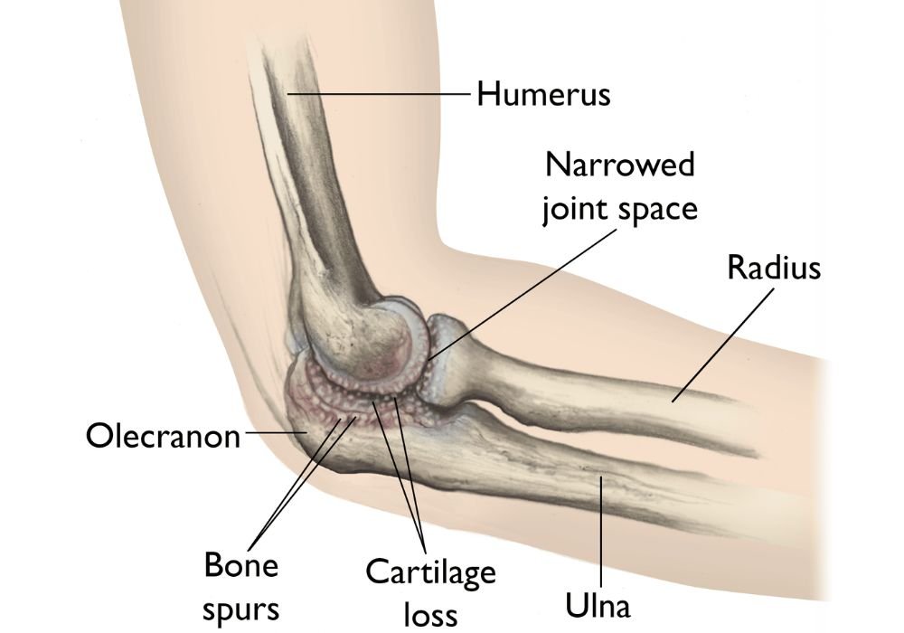 Elbow osteoarthritis 
