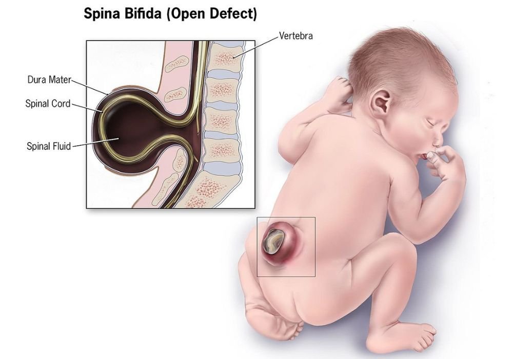 spina bifida