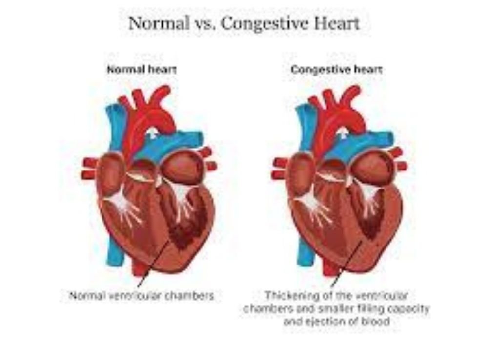 Congestive cardiac failure (CCF)