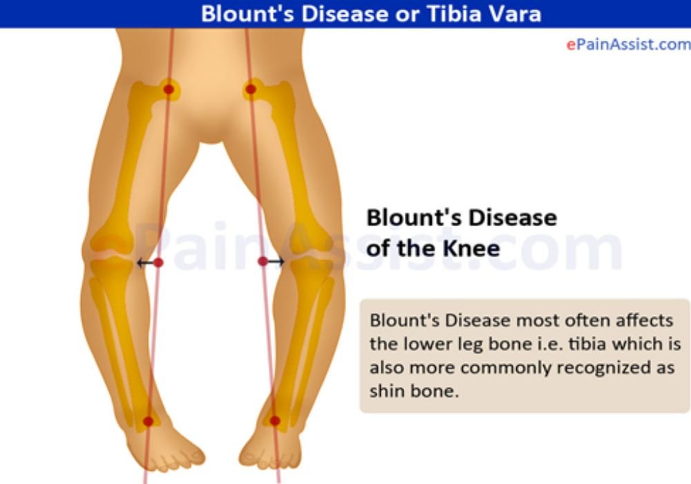 Blount’s disease