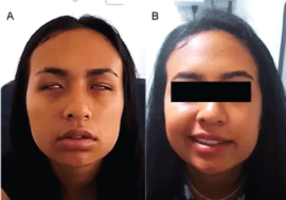 Bilateral Facial Palsy