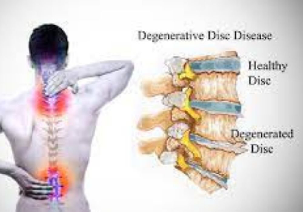 Disk disorders of back 