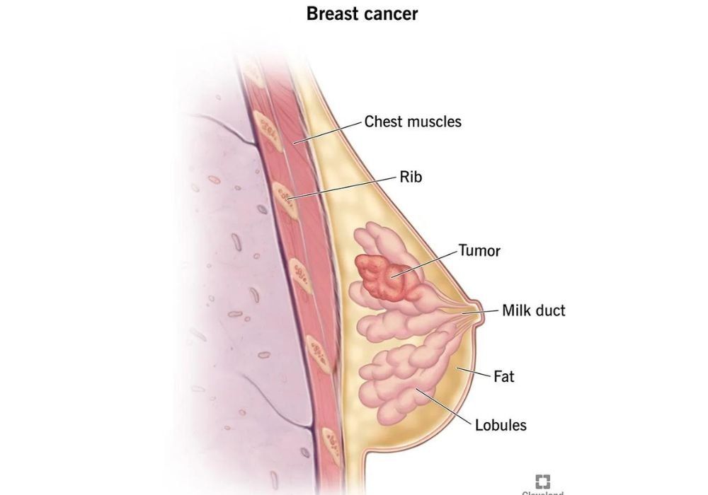 Breast Cancer Recovery 