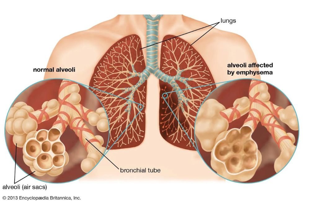 COPD ( chronic obstructive pulmonary disease)