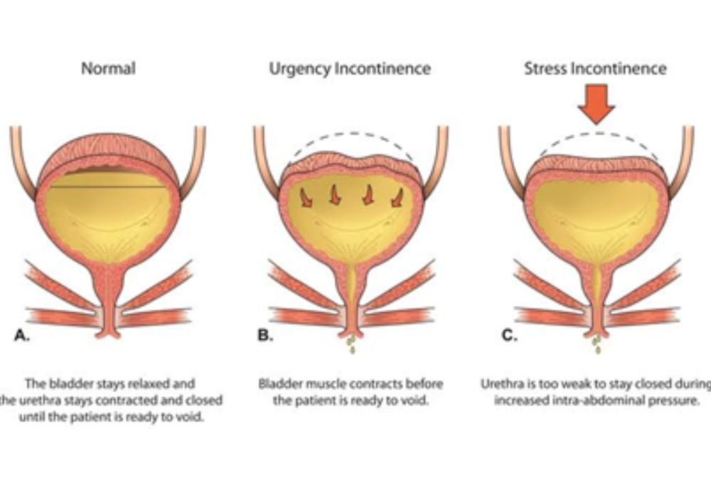 URINARY INCONTINENCE 