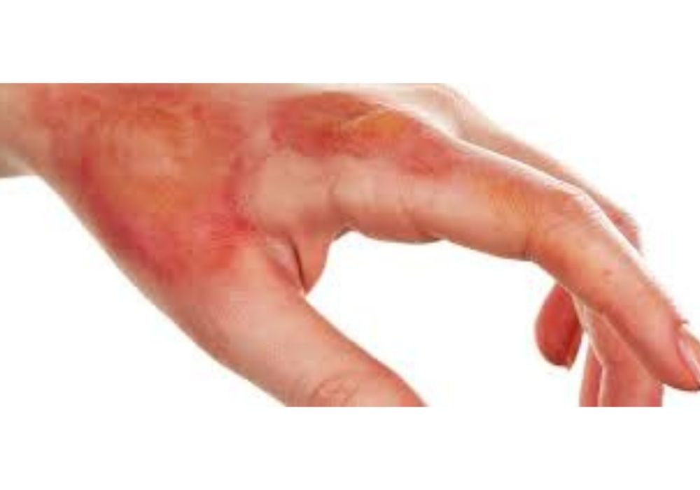 Rehabilitation of Hand Burn Injuries