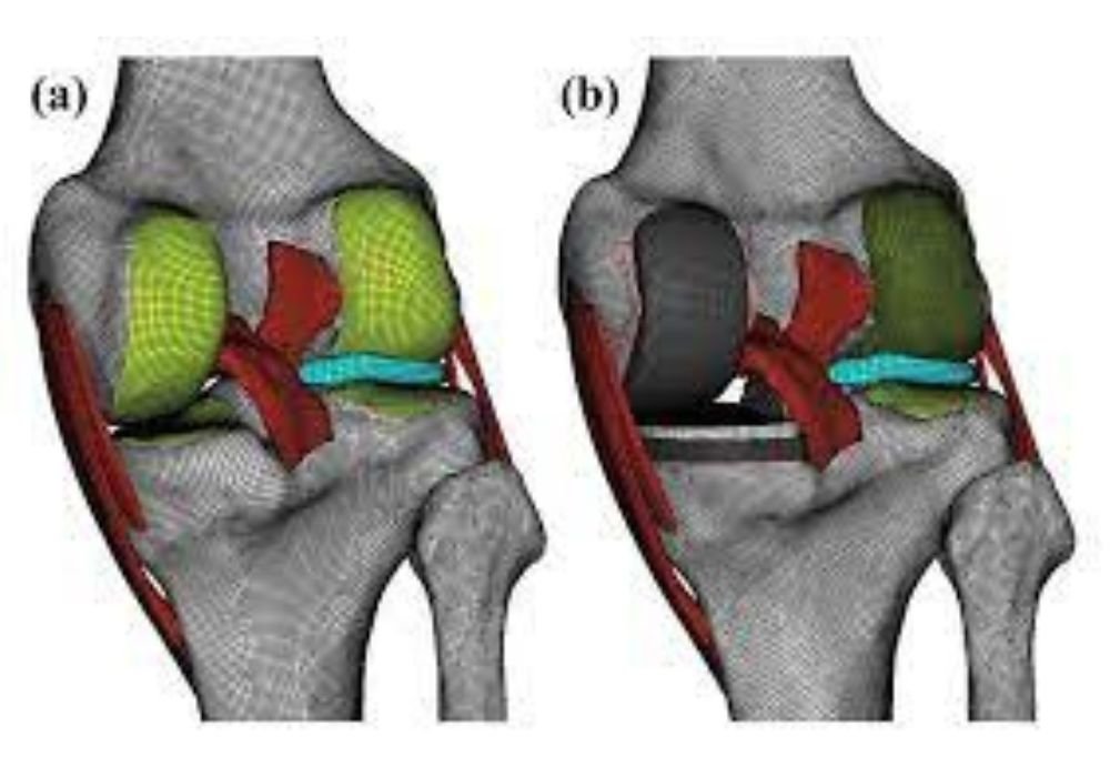 Biomechanical assessment of knee biomechanical  