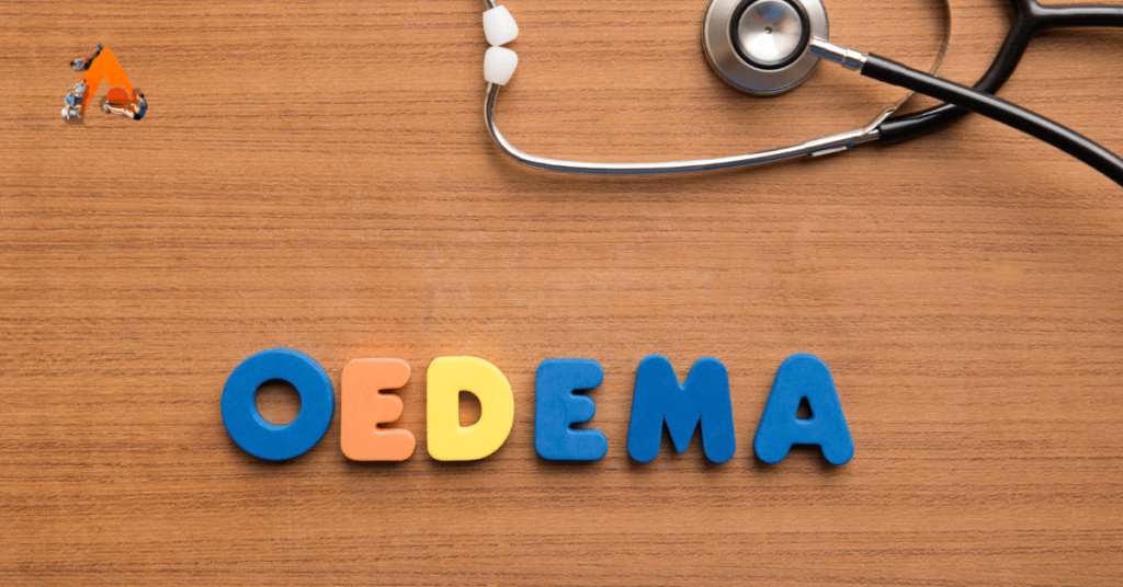 Oedema