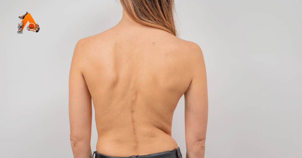 Duchenne Muscular Dystrophy ( Scoliosis )