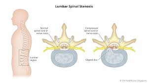 Lumbar Spinal Stenosis