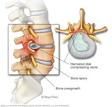 Lumbar Spinal Stenosis