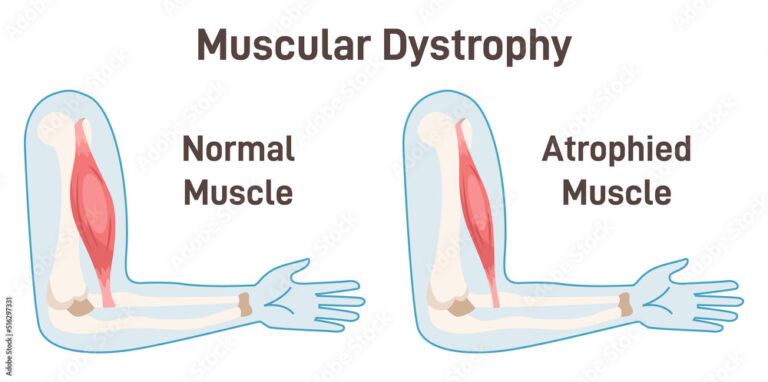 Muscular Dystrophy