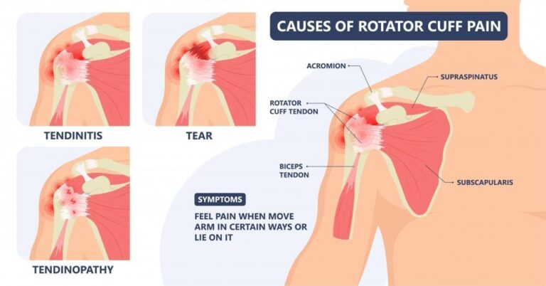 Rotator Cuff Strain