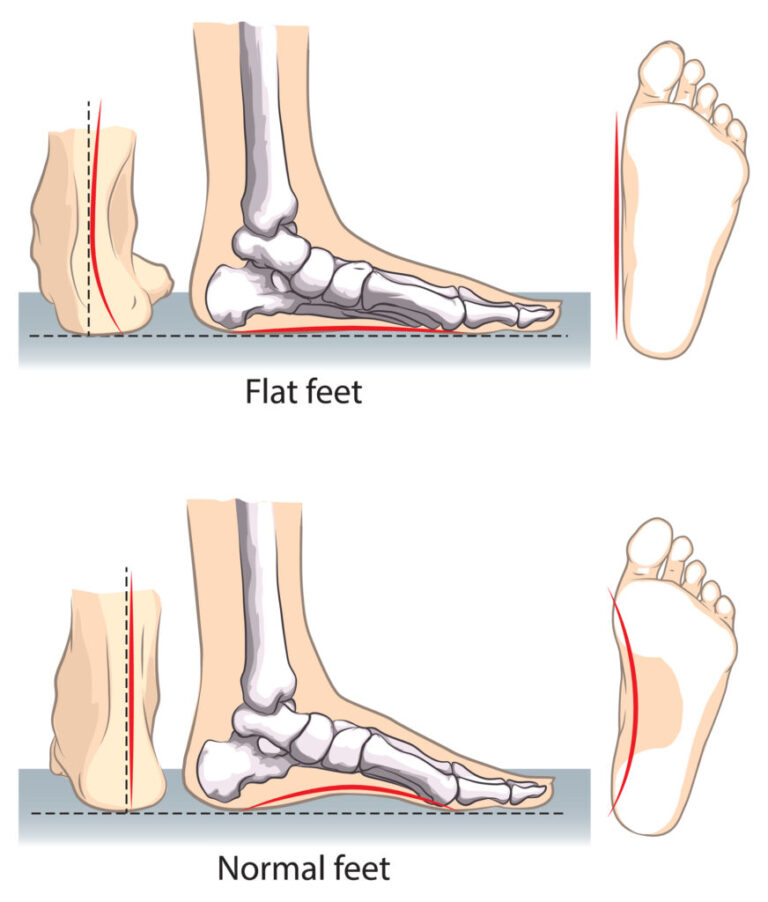 Flat Foot