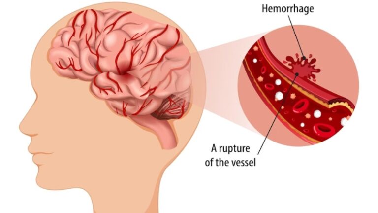 Stroke – Paralysis Physiotherapy