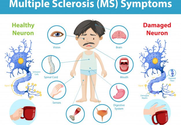 Multiple Sclerosis