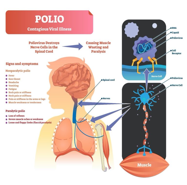 Post Polio Syndrome