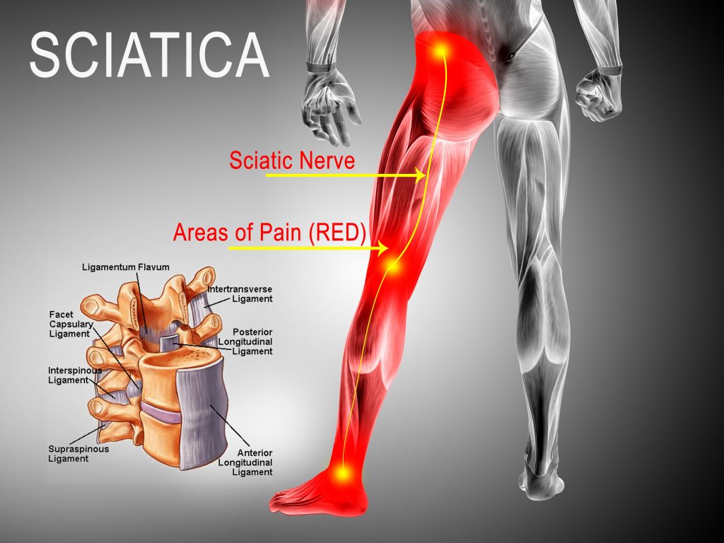 sciatica pain management