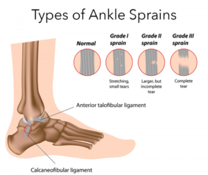 types-of-ankle-sprains