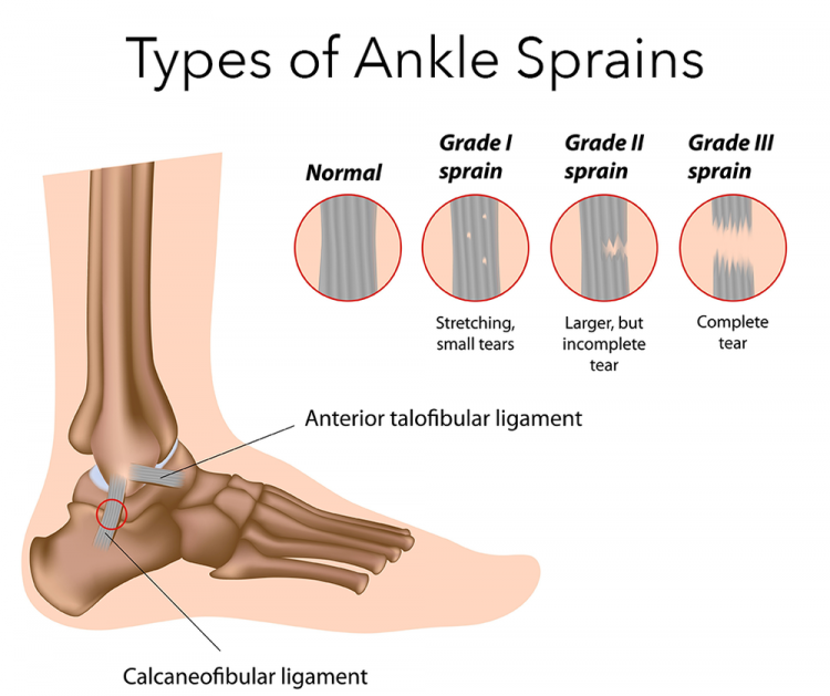 Ankle Sprain