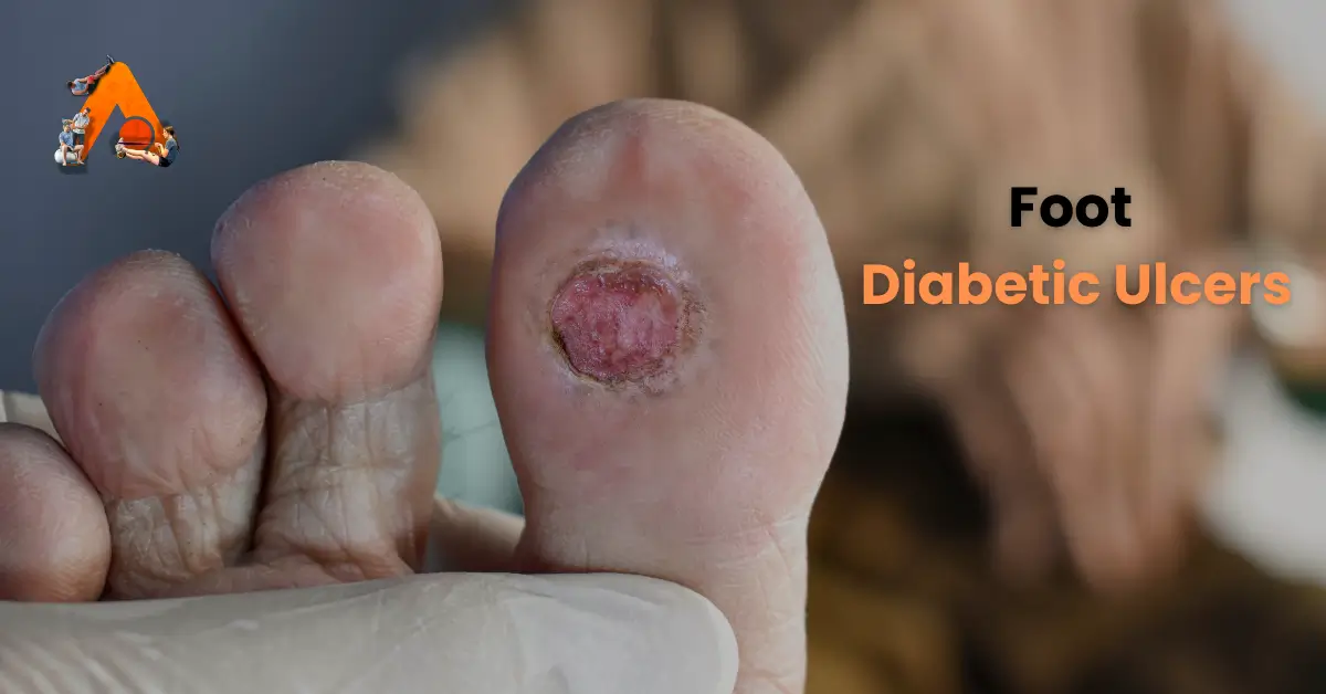 Diabetic Ulcers