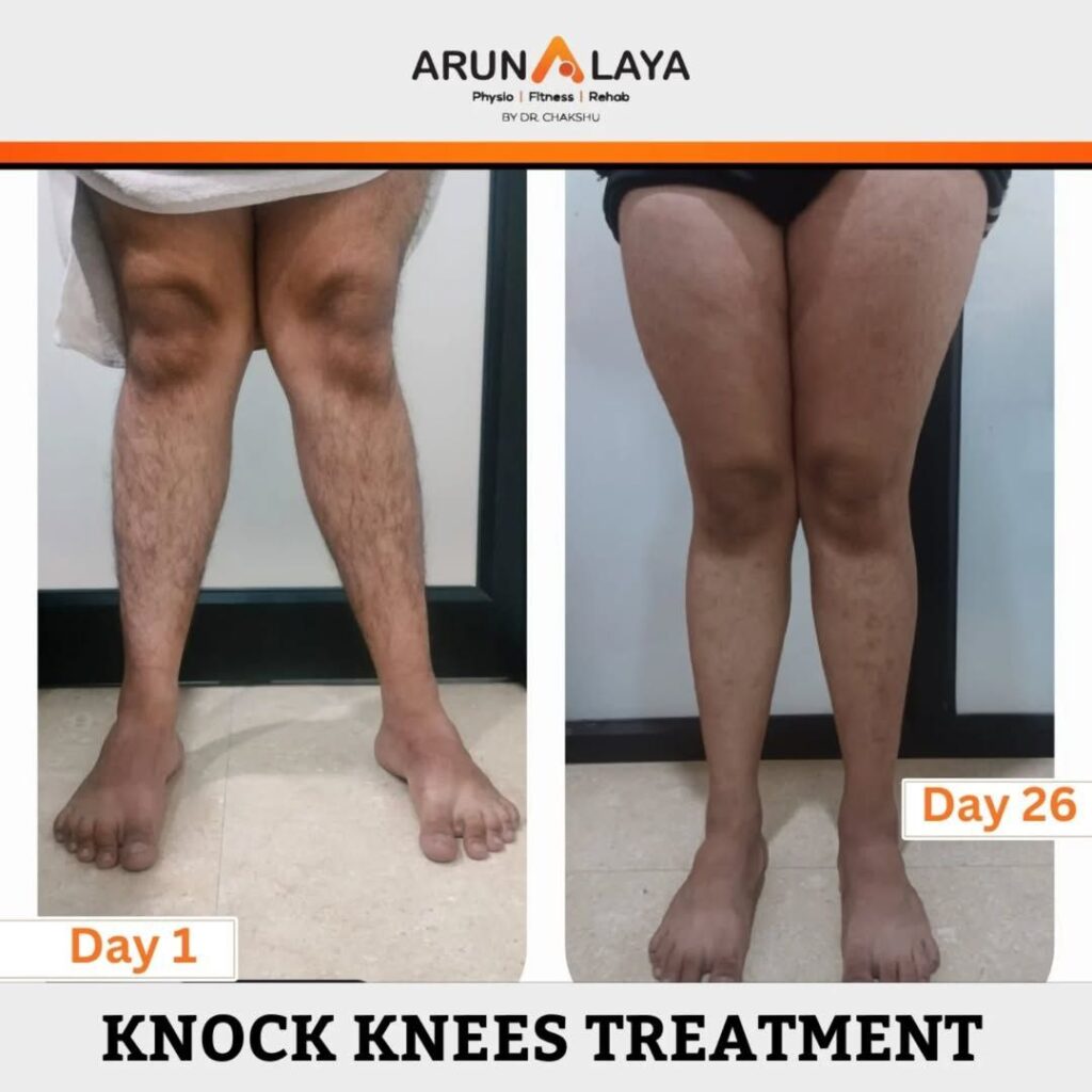 adult knock knees treatment