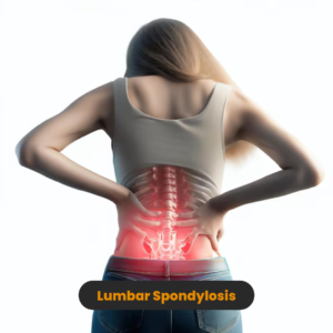 Lumbar Spondylosis
