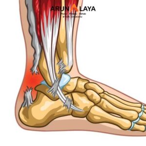 Achilles Rupture treatment at arunalaya