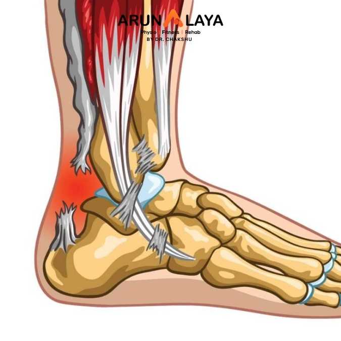 Achilles Rupture treatment at arunalaya
