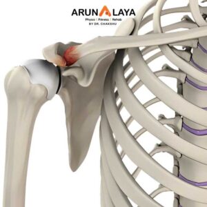 Acromioclavicular joint Disorder treatment at Arunalaya