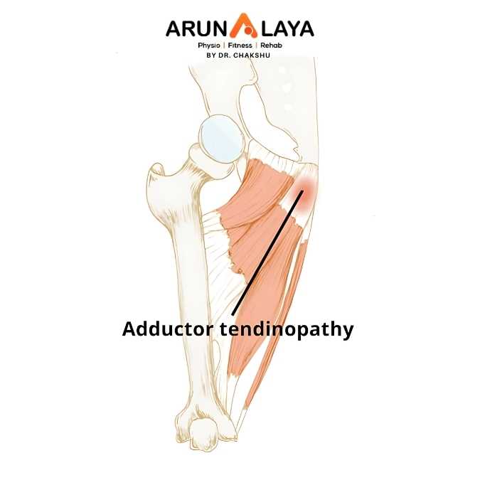 Adductor Tendinopathy treatment at Arunalaya