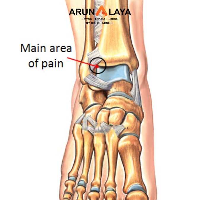 Anterior Ankle Impingement Syndrome
