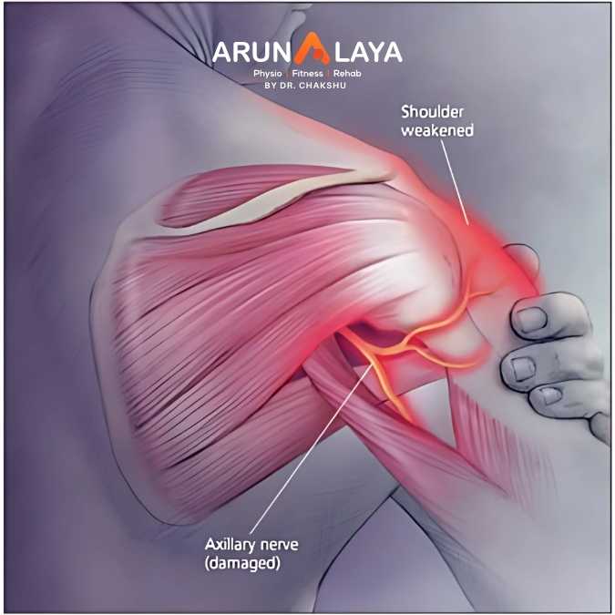 Axillary nerve injury treatment at Arunalaya