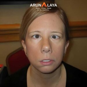 Bilateral Facial Palsy treatment at Arunalaya