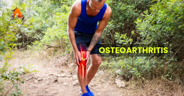 Osteoarthritis: Causes, Symptoms, & Physiotherapy Management