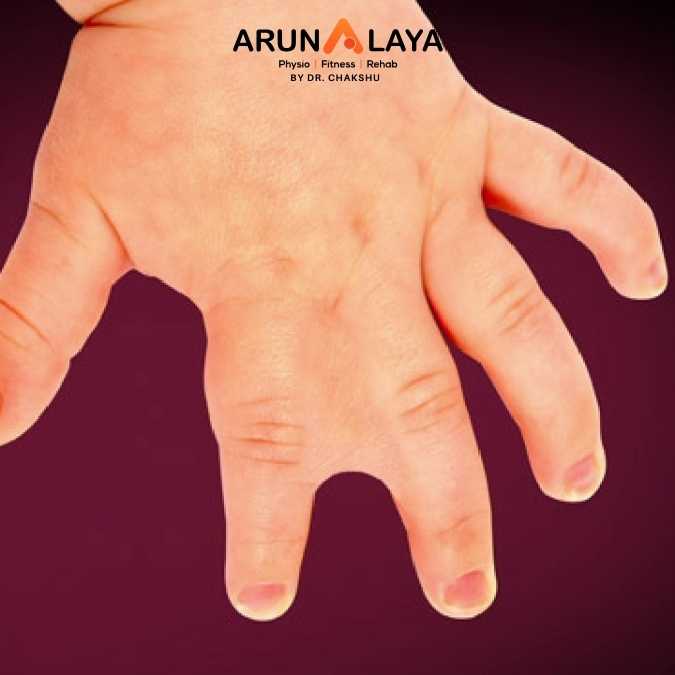 Congenital Hand Deformities