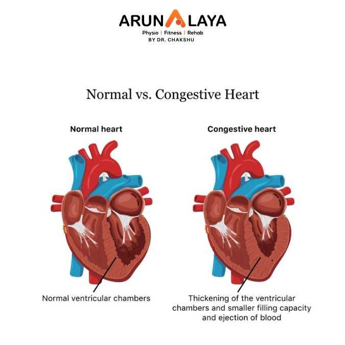 Congestive cardiac failure (CCF) treatment at Arunalaya