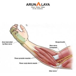 Cubital tunnel syndrome treatment at Arunalaya