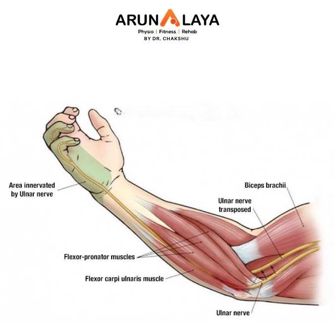 Cubital tunnel syndrome treatment at Arunalaya