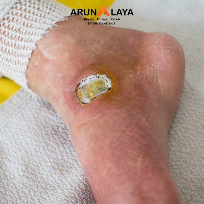 DIABETIC NEUROPATHY treatment at Arunalaya