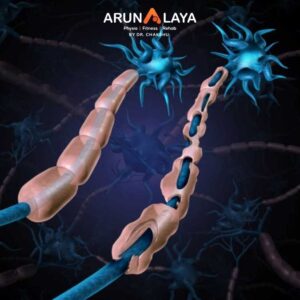 Demyelinating Disorders treatment at Arunalaya