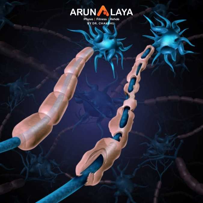 Demyelinating Disorders treatment at Arunalaya